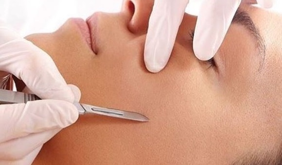 Dermaplaning hair removal at Springs Beauty Salon in Warrington Dermaplaning hair removal at Springs Beauty Salon in Warrington