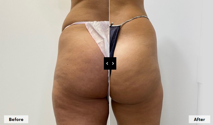 Mesoestetic Bodyshock at Springs Beauty Salon in Warrington, Cheshire