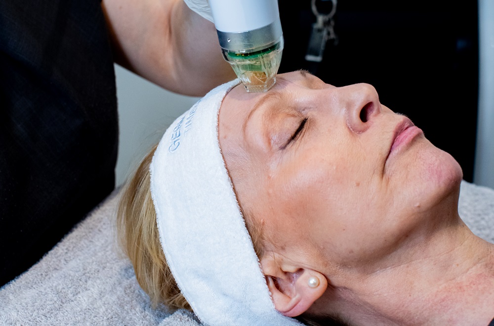 RF Microneedling at Springs Beauty Salon in Warrington